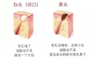 辨别黑头与闭口，黑头仪的正确使用与误区